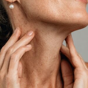 Fotorejuvenecimiento Láser Cuello + Escote