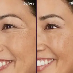 Patas de Gallina (ambos lados)