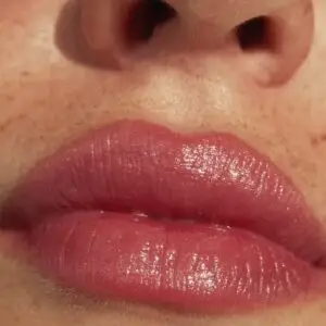 Botox Lip Flip